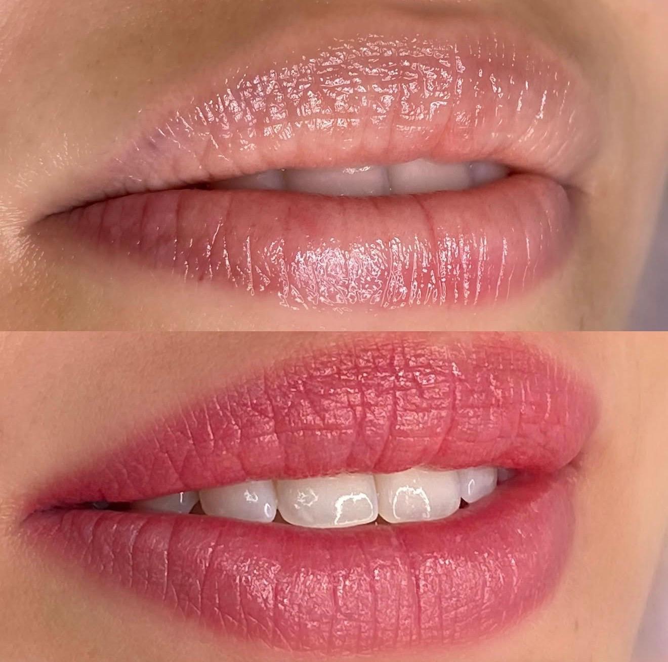 Antes e depois Tratamento labial