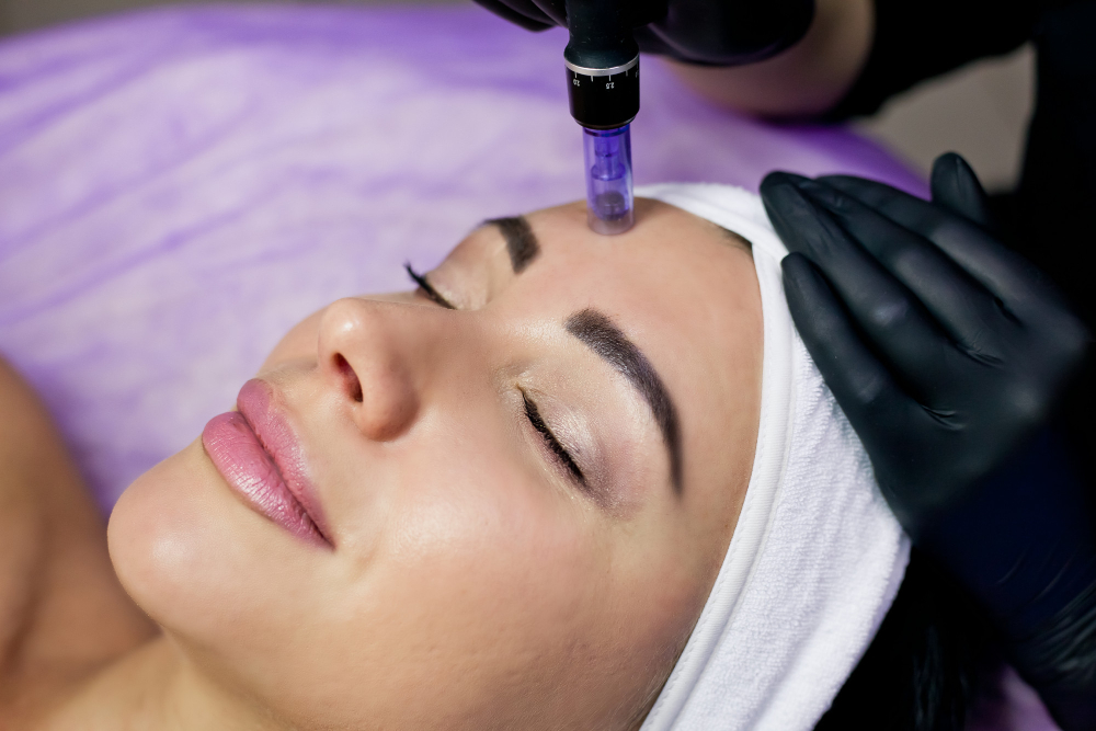 Microagulhamento facial