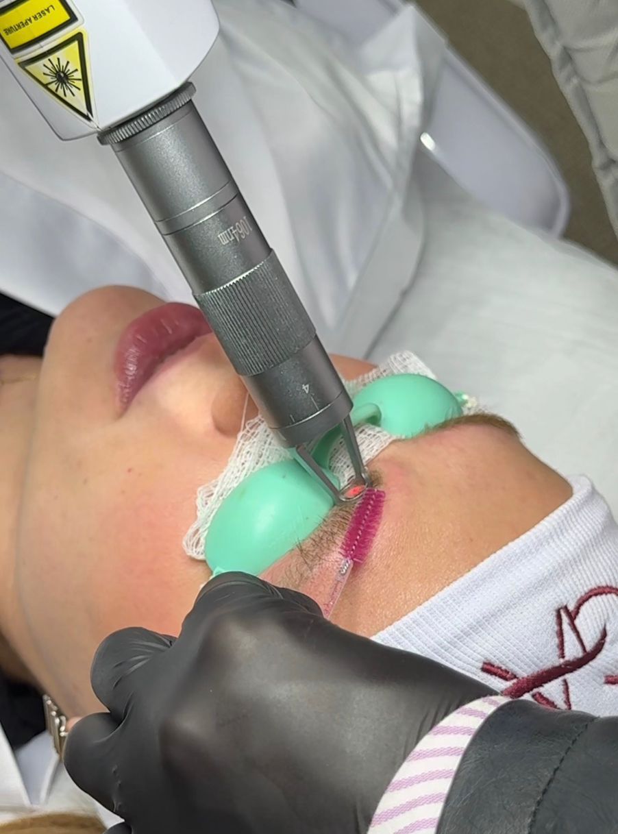 Remoção a laser micropigmentação e tatuagem